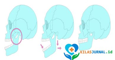 Sering Bangun dengan Rahang Pegal? Bisa Jadi Kamu Bruxism