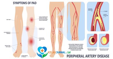 Penyakit Arteri Perifer Mulai Menyerang Usia Muda, Kenali Gejala dan Faktor Risikonya